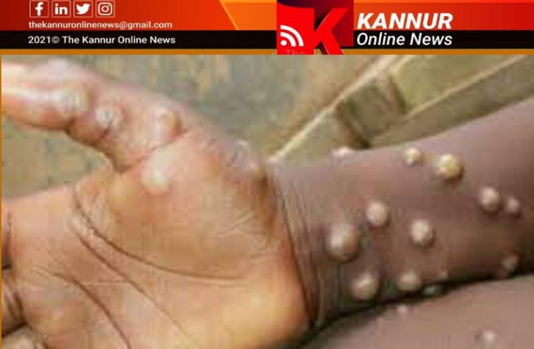 വാനരവസൂരി-രോഗി സുഖം പ്രാപിക്കുന്നു-