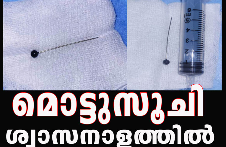 യുവതിയുടെ ശ്വാസനാളത്തില്‍ കുടുങ്ങിയ മൊട്ടുസൂചി പുറത്തെടുത്തു.